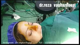 فیلم عمل زیبایی بینی (دکتر رضا وقردوست)( پارت 8)