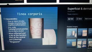 تشخیص قطعی بیماریقارچی با نمونه برداری پوست .دکتر مقیمی