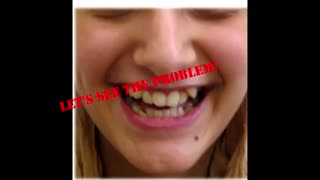 صاف کردن دندان های بسیار نامرتب بدون کشیدن دندان با ارتودنسی دیمون