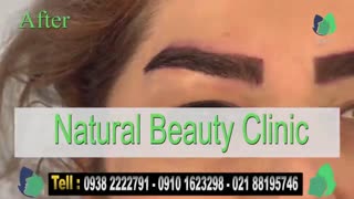 نمونه کار کاشت ابرو- قبل و بعد از کاشت !!!- نچرال بیوتی