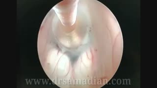 عمل جراحی ونتریکولوستومی آندوسکوپیک بطن سوم(ETV)