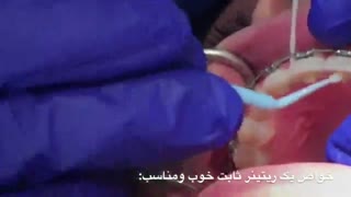 مراحل ارتودنسی: جلسه آخر - اتصال ریتینر و بازکردن