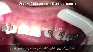 مراحل ارتودنسی : شروع کار ارتودنسی ثابت با سیستم دیمون (چسباندن براکت ها)