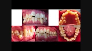 قبل و بعد ارتودنسی توسط دکترگوگانی - بی نظمی و کمبود فضای شدید