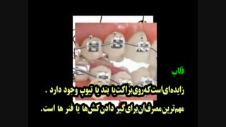 اجزای ارتودنسی ثابت - معرفی توسط دکترگوگانی