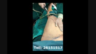 لیپوماتیک - دکتر ابدالی - 22807060 پیلینگ شیمیایی