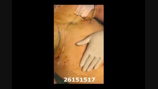 لیپوماتیک - دکتر ابدالی - 22807060 لیپوماتیک
