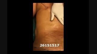 لیپوماتیک - دکتر ابدالی - 22807060 اینسایزینگ