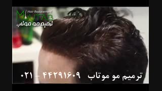 ترمیم مو بدون جراحی 02144291609
