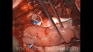 عمل جراحی تومور نخاع با استفاده از نورومانیتورینگ