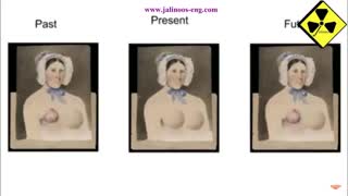 عوامل ابتلا به سرطان سینه