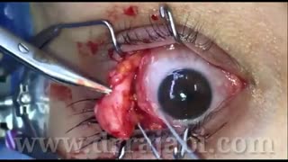 جراحی تومور لیپودرمویید