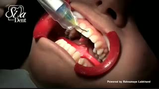 قبل و بعد درمان کامپوزیت ونیر | دندانپزشکی سیمادنت