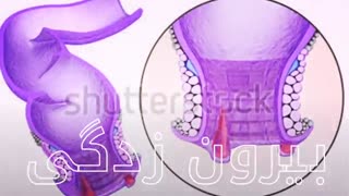 درمان میشه بدون جراحی www.castelinagold.com