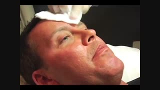 آموزش تزریق بوتاکس لیزر موهای زائد