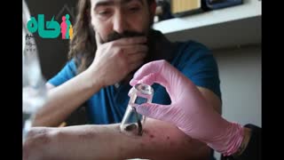 زالو درمانی و دیدگاه طب سنتی به آن