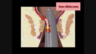 درمان بواسیر