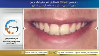 ارتودنسی کاموفلاژ با کمک مینی اسکرو | دکتر داوودیان
