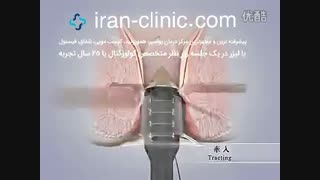 درمان بواسیر با استاپلر