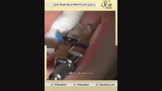 پرکردن دندان با مواد کامپوزیتی | دندانپزشکی سیمادنت