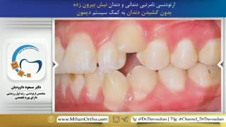 قبل و بعد ارتودنسی دیمون | دکتر مسعود داوودیان