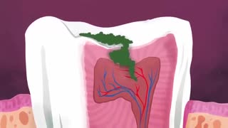 چه چیزهایی باعث پوسیدگی دندان می شوند ؟