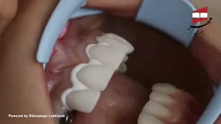 اصلاح طرح لبخند | کلینیک تخصصی مهر زعفرانیه