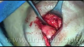 تومور مادر زادی (درموئید) در بالای ابرو