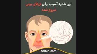 خطر جدی کندن موی داخل بینی، مثلث خطر - آنی بین