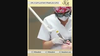 بلیچینگ (سفید کردن دندان) | دندانپزشکی سیمادنت لیزر فرکشنال