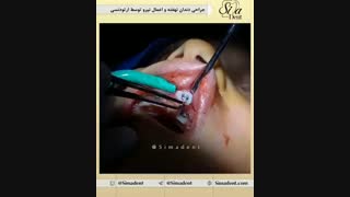 دندان نهفته و ارتودنسی | دندانپزشکی سیمادنت