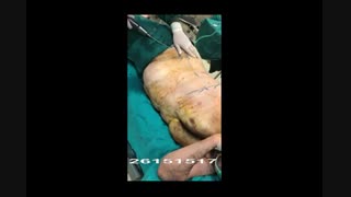 لیپوماتیک - دکتر ابدالی -22807060 پلاستیک لثه