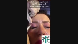 پلاسما تراپی