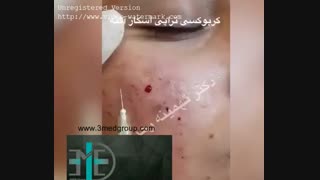 کربوکسی تراپی لیپوست