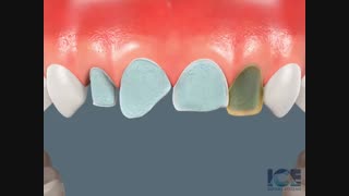 ونیر | کلینیک دندانپزشکی تاج