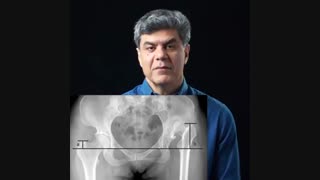 درمان دررفتگی مادرزادی لگن در بزرگسالان چگونه است