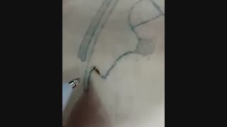 در آوردن تتو با دستگاه لیزر بیوتی پن