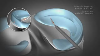 آرتروسکوپی زانو