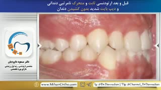 ارتودنسی ثابت و متحرک | دکتر مسعود داوودیان