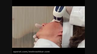 جوانسازی صورت با دستگاه مدیو استار