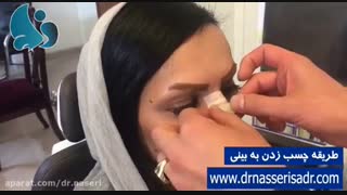 چسب زدن بینی توسط دکتر ناصری صدر برداشتن توده