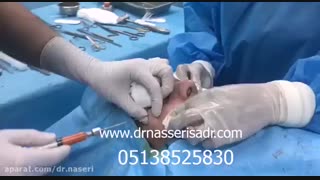جراحی بینی به روش باز همراه با تزریق چربی