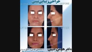 نمونه کار های جراحی بینی