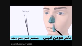 جراحی قوز بینی