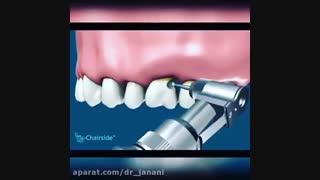 برداشت پوسیدگی زیر لثه