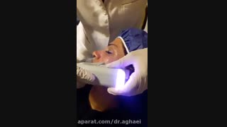 هایفو ( دابلو ) اصلاح فرم صورت