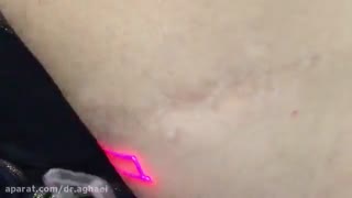 درمان اسکار با لیزرفرکشنال دندانپزشک زیبایی