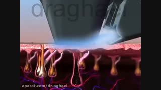لیزر موهای زائد اتوپلاستی