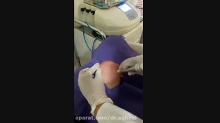 میکرودرم پروتز سینه
