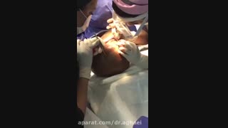 کاشت موی حرفه ای توسط دکتر حمیده آقایی بررسی لک صورت